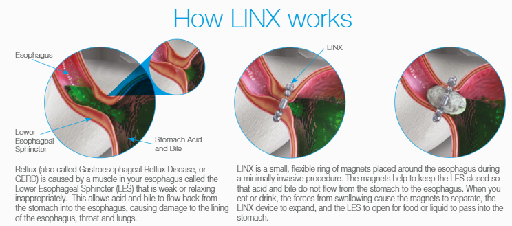 Linx Reflux Management System